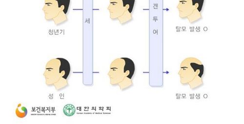 남성 대머리막는 확실한방법.jpg