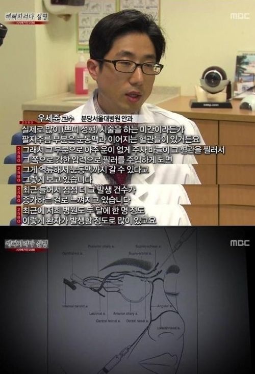 필러시술의 위험성.jpg