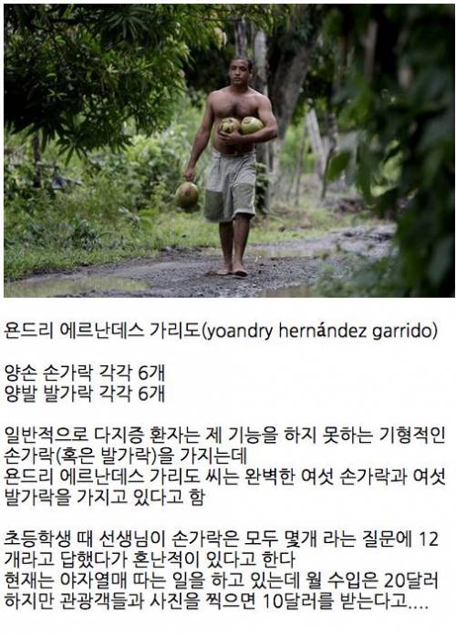 쿠바의 다지증 남자.jpg