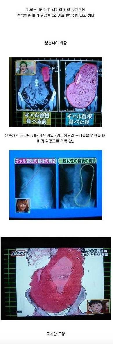 폭식했을때 위장의 상태.jpg