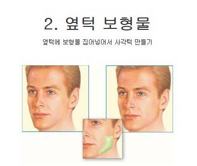 서양에서 많이 하는 성형수술