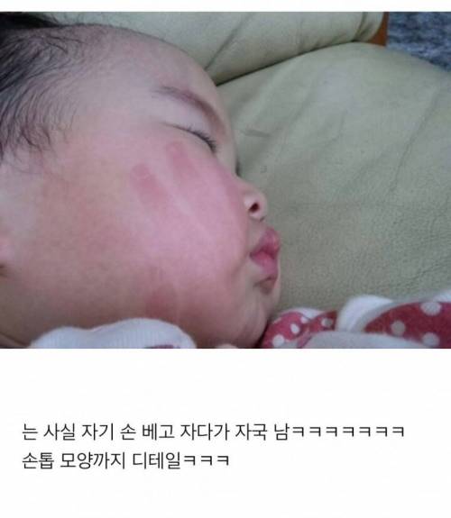 손자국난 아기.jpg