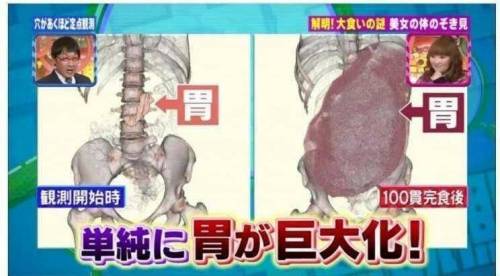 일본 어느대식가의 위.jpg