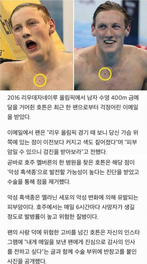 팬 덕분에 암 발견한 수영선수