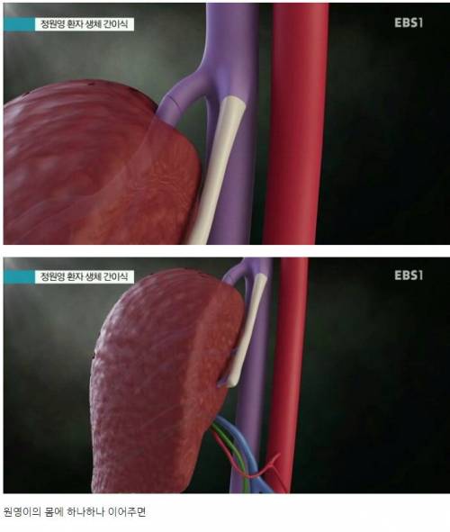 간이식수술 방법 .jpg