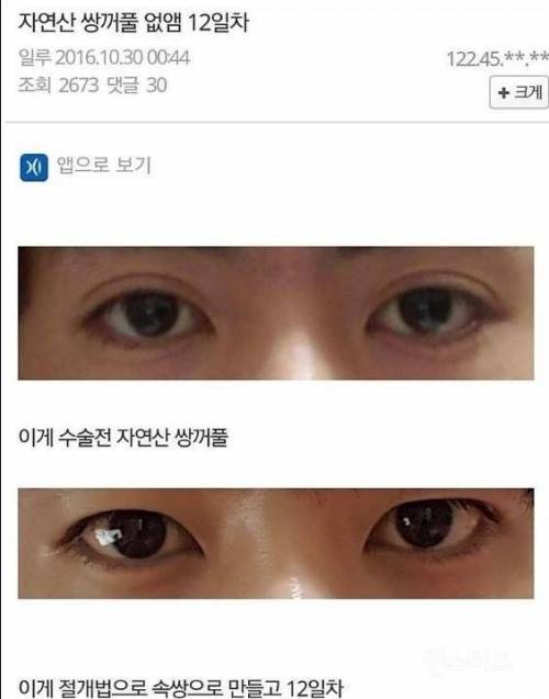 자연산 쌍꺼풀 없애는 수술.jpg