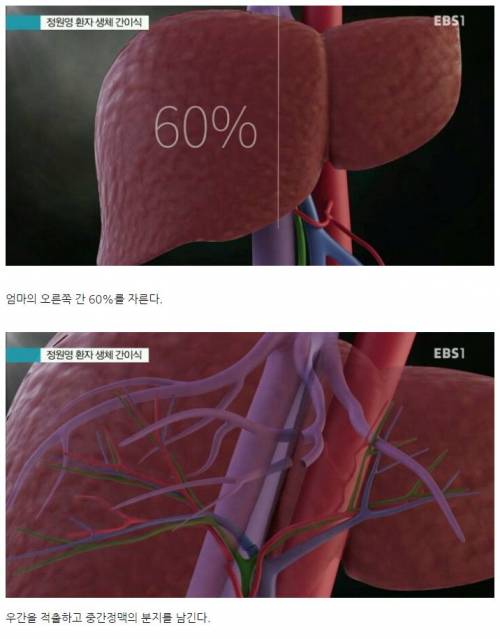 간이식수술 방법 .jpg