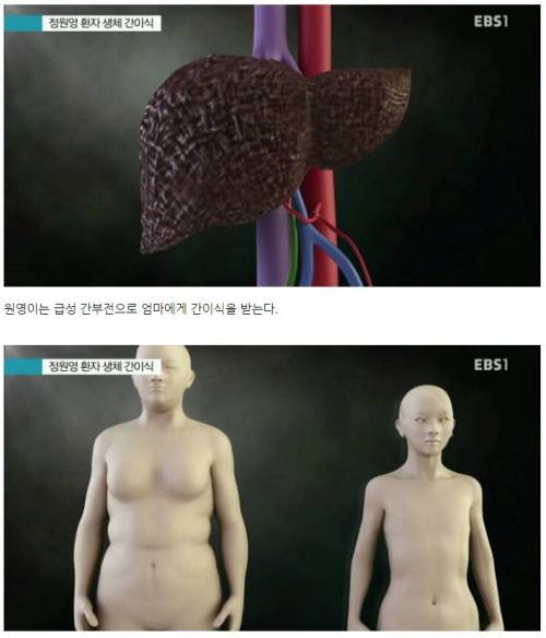 간이식수술 방법 .jpg