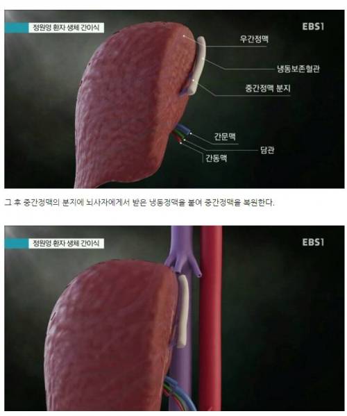 간이식수술 방법 .jpg