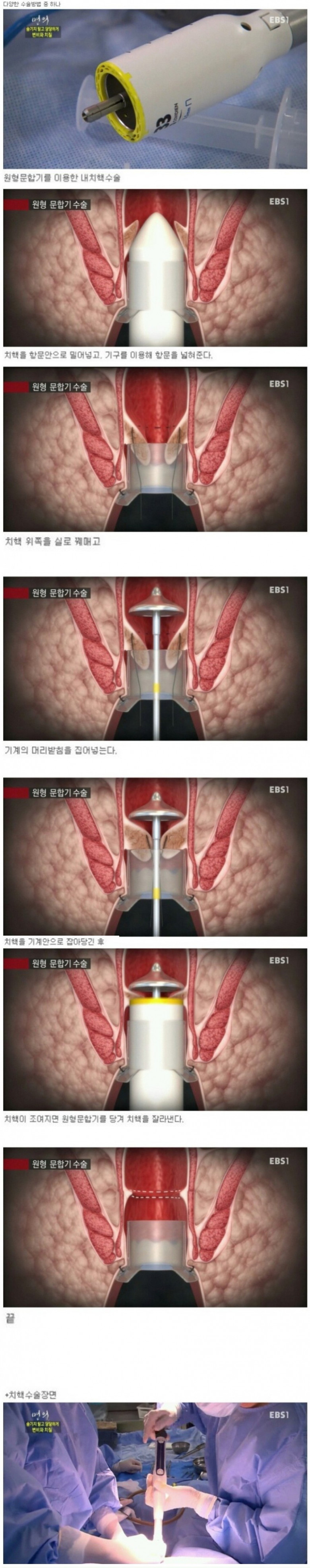 치질수술 과정 및 후기.jpg