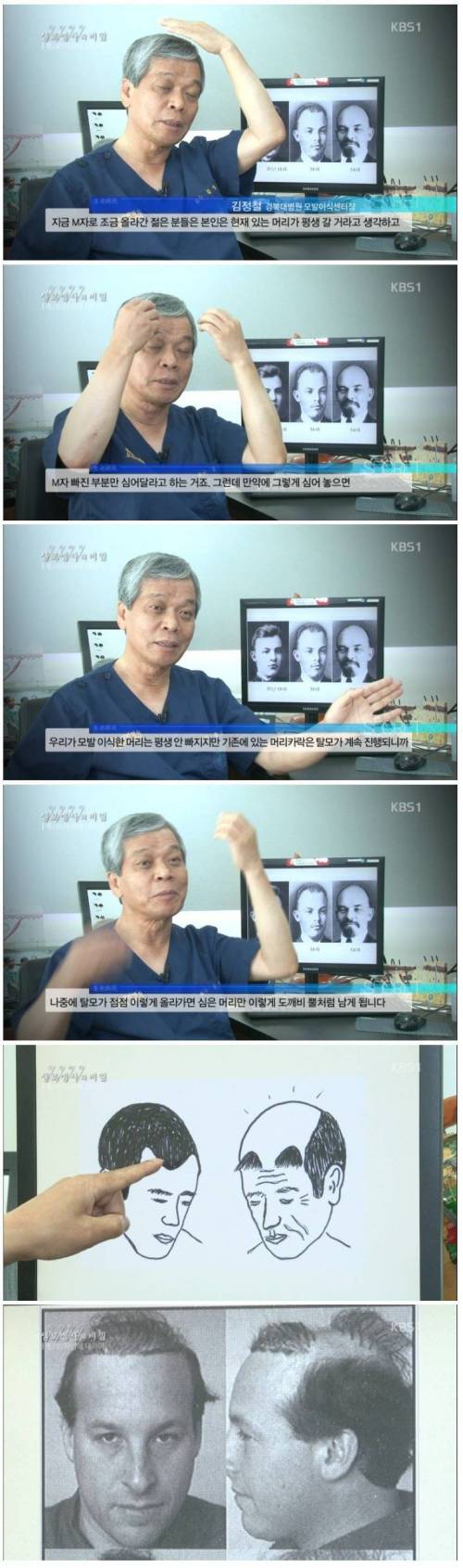 모발이식의 충격적 진실.jpg