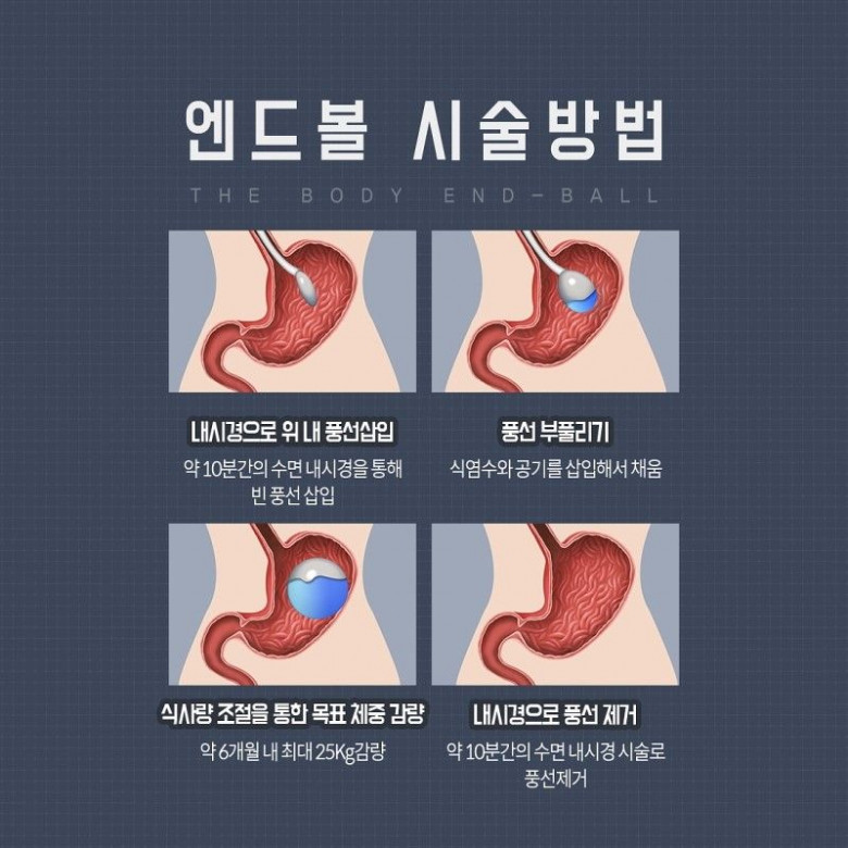 위절제술 대신 늘어나고 있는 다이어트 시술.jpg