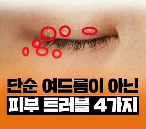 단순 여드름이 아닌 피부 트러블 4가지.jpg