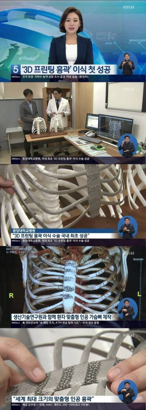 3D프린팅 흉곽 이식.jpg