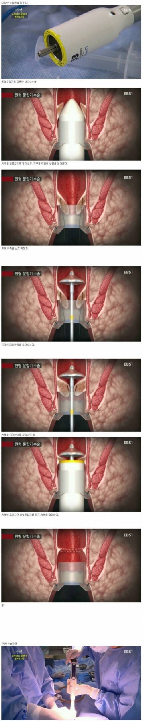 [스압] 치질수술 과정 및 후기.jpg