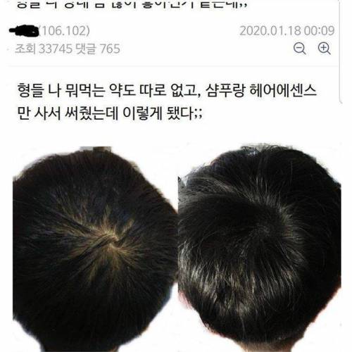 얼떨결에 풍성해진 탈모인 레전드