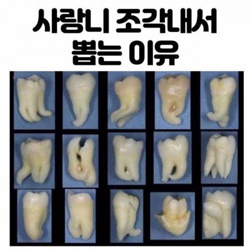 사랑니를 조각내서 뽑는 이유