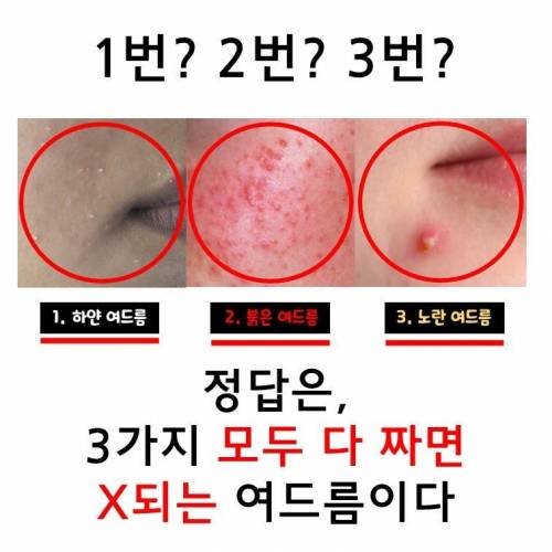 다음 중, 짜면 X되는 여드름은?.jpg