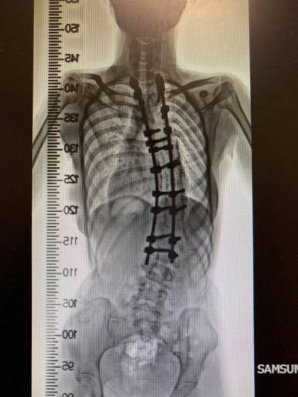 심각한 척추측만증으로 몸이 이상하게 휘어버린 10대 소녀