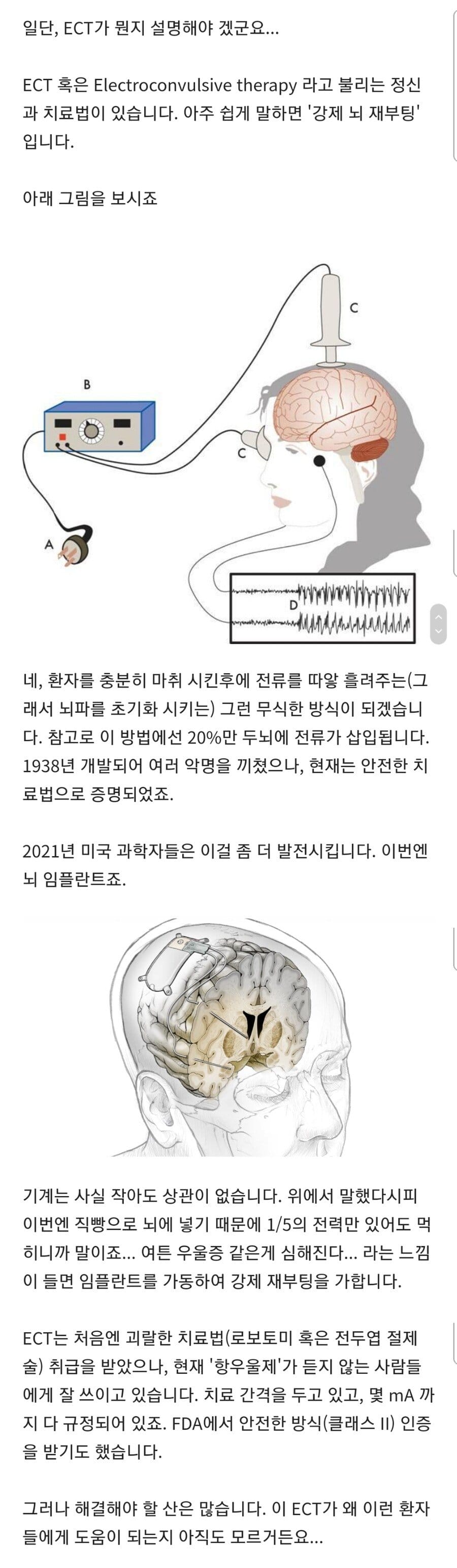 뇌를 강제 재부팅하는 우울증 치료법.jpg