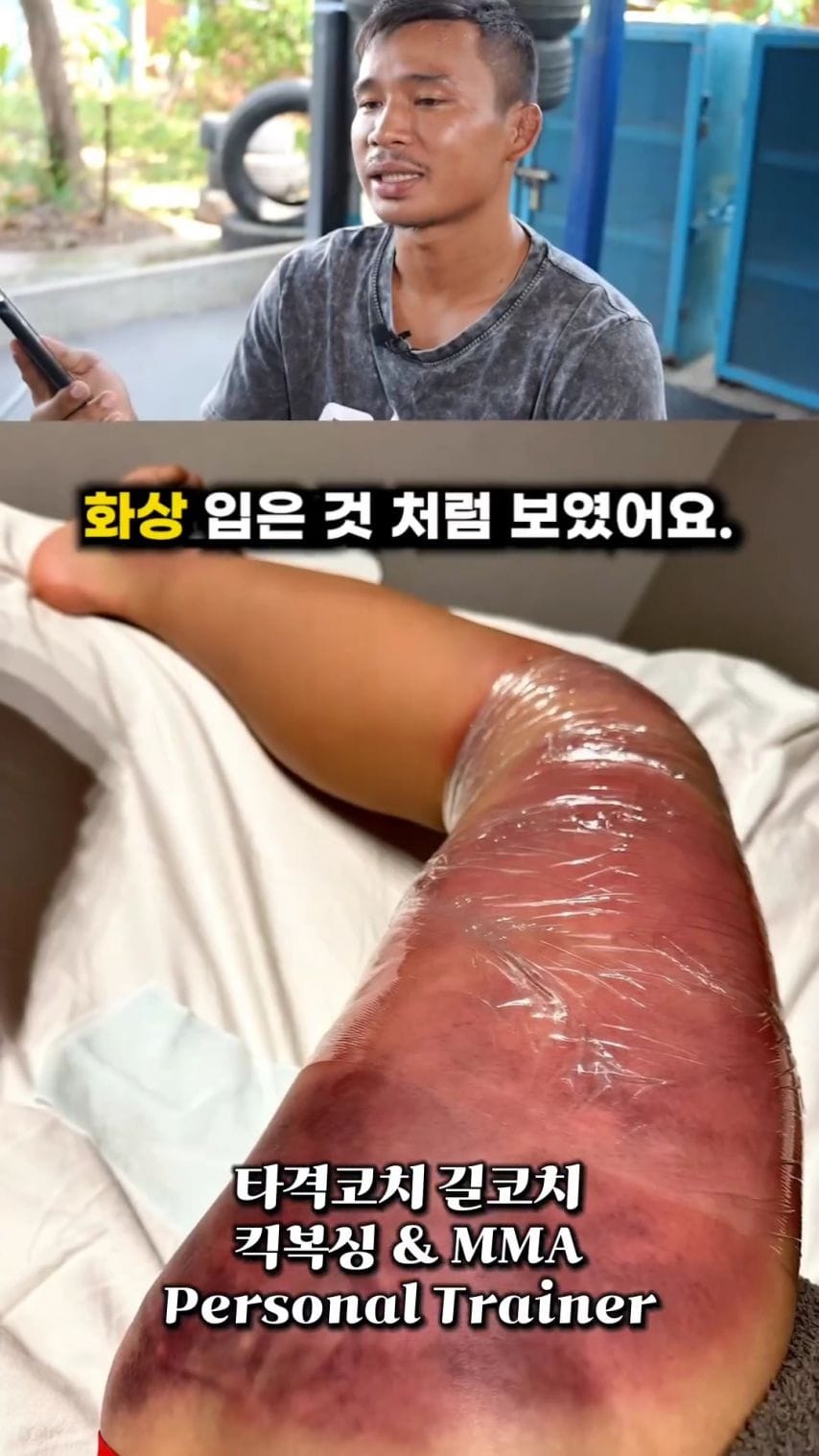 킥복싱에서 여러번 로우킥 맞은후 허벅지 모습.jpg