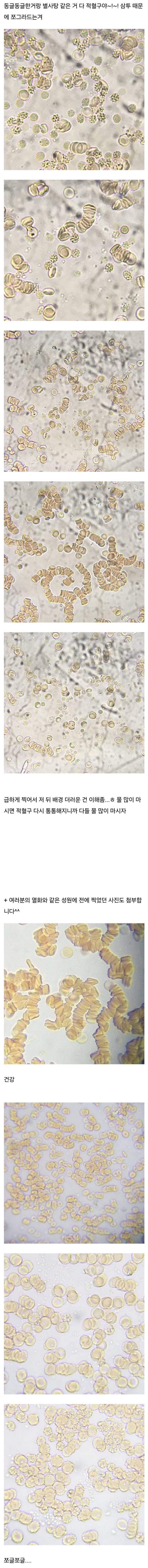 건강 - 인티] 물을 조금 마셨을 때 적혈구 모양.jpg