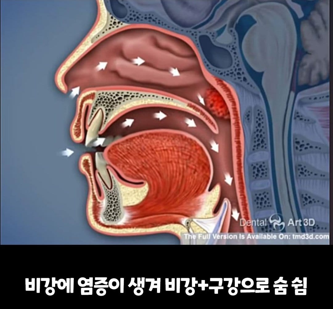 비염의 무서움 ㅎㄷㄷ