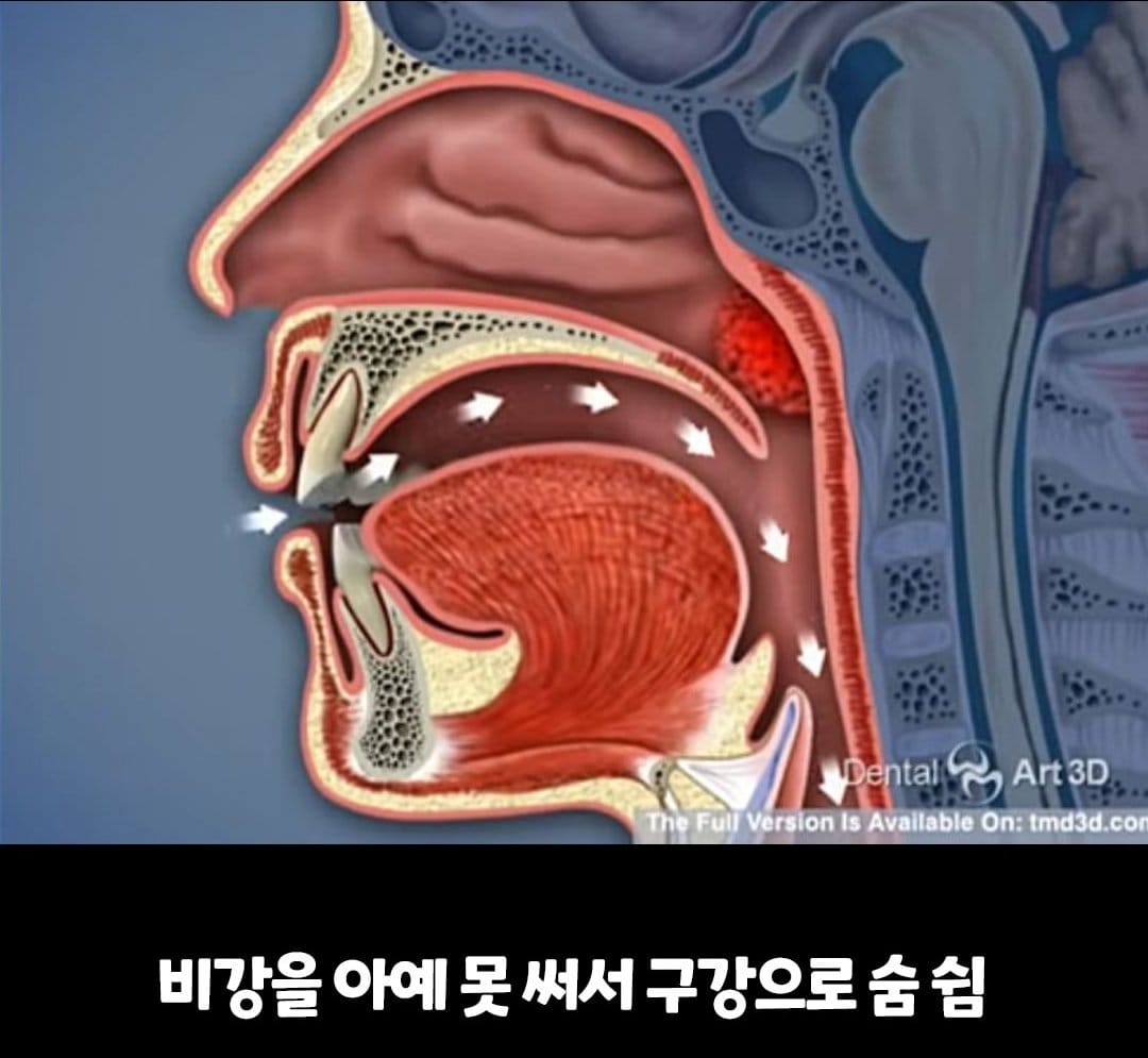 비염의 무서움 ㅎㄷㄷ