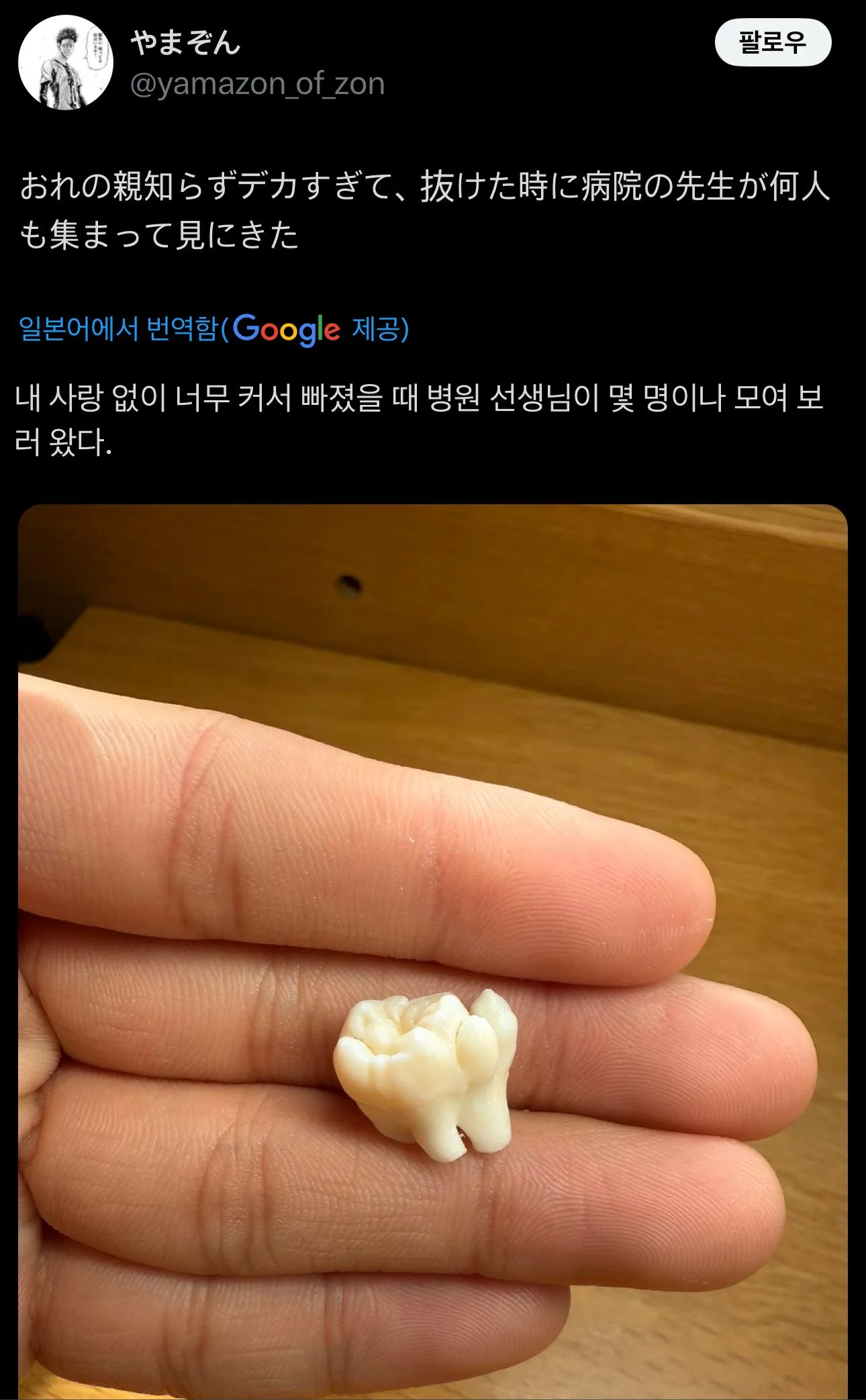 사랑니가 너무 커서 뺄 때 치과의사들이 구경왔다는 일본인