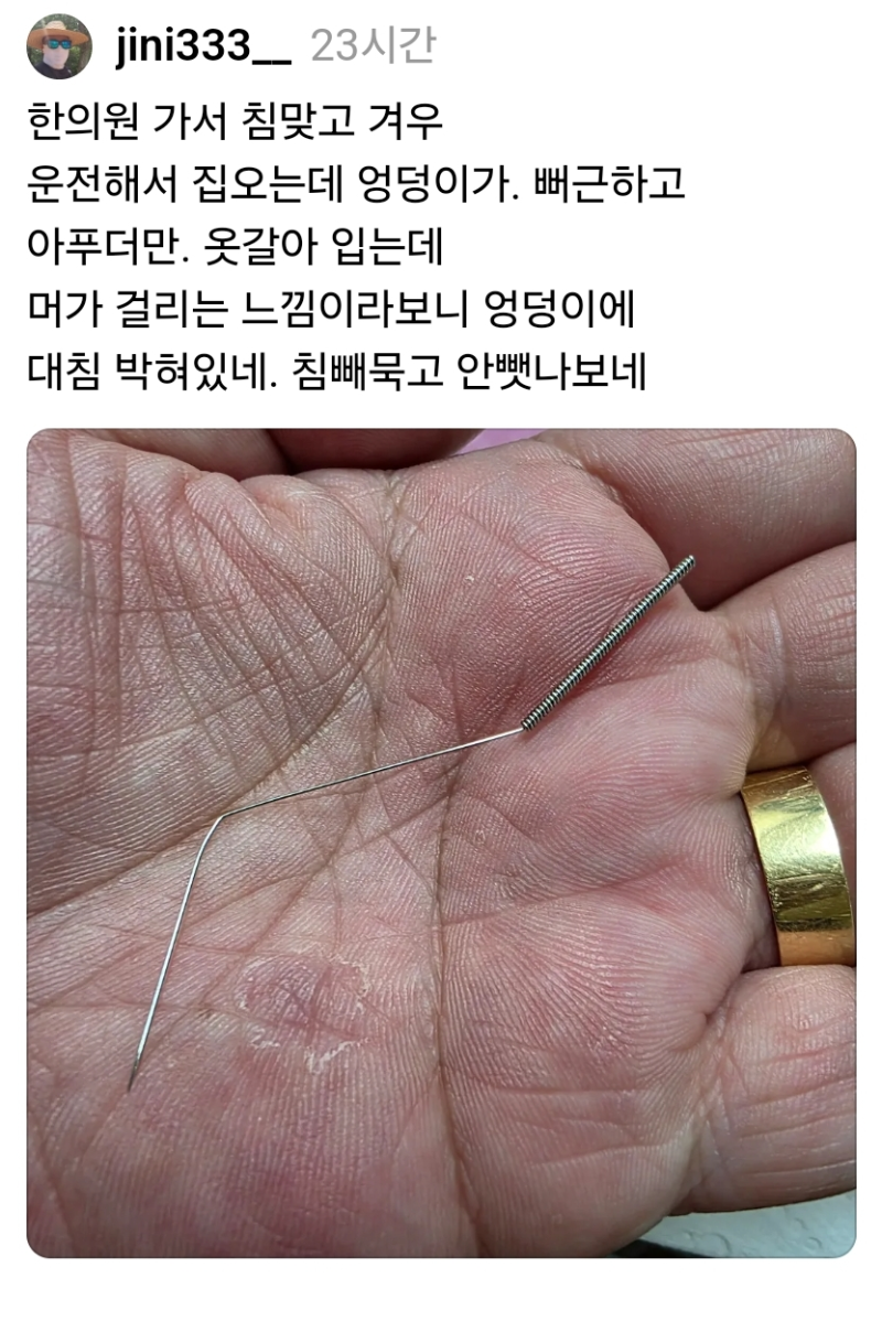 한의원 가서 침 맞았는데 엉덩이가 너무 아픔